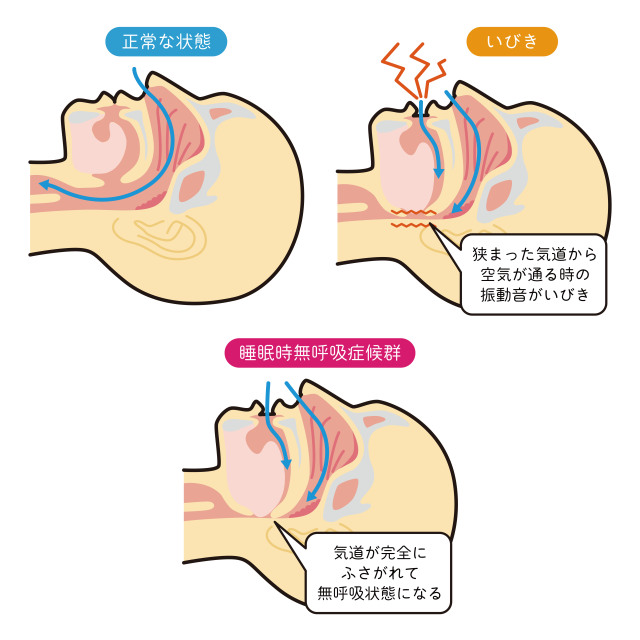 板橋区の方に睡眠時無呼吸症候群を解説