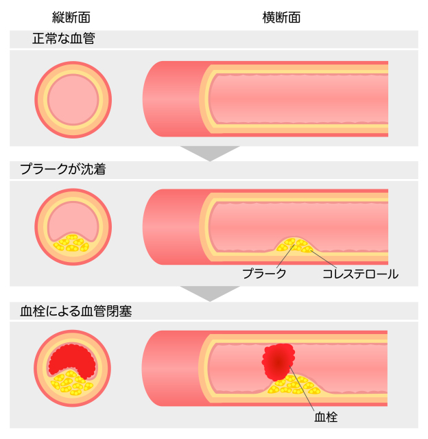 板橋区で動脈硬化症なら光が丘クリニックへ