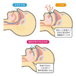 睡眠時無呼吸の解説