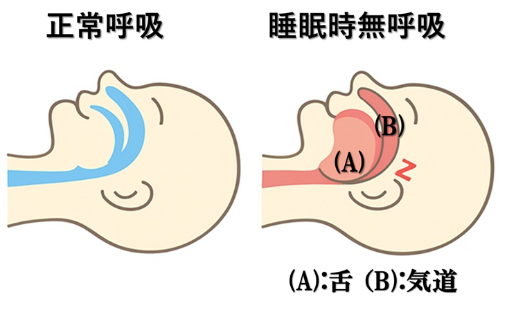 睡眠時無呼吸症候群|板橋区・練馬区